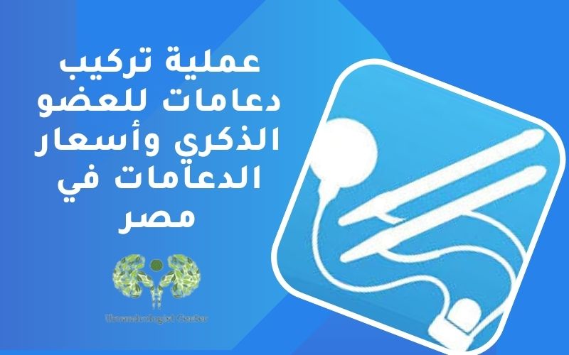 عملية تركيب دعامات للعضو الذكري وأسعار الدعامات في مصر